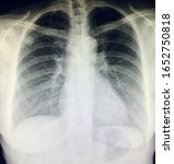 Small photo of X-ray image of chest, thorax PA upright shows nodule at right upper lobe(RUL).Abnormal pulmonary opacity at right side.Medical education known case studies Metastatic Non-Small Cell Lung Cancer(NSCLC)