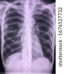 Small photo of Film human chest X-ray with history pulmonary TB. Pulmonary opacity. Pulmonary nodule at RUL.