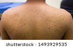 Small photo of A physical of folliculitis , multiple pustulated inflamatory papule on skin of neck and back of man,closeup , selected focus