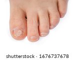 Small photo of Toenail fungus infection. Partial foot close up. All toenails are milky yellow discolored, oddly shaped and deformed and cracked (Onycholysis). Isolated on white.