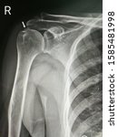 Small photo of X-ray image shows right shoulder with calcified supraspinatus tendon.