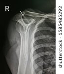 Small photo of X-ray image(lateral scapula view) shows right shoulder with calcified supraspinatus tendon.