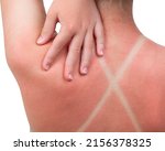 Small photo of Sunburn. Girl got a Sunburn. Red painful skin on back that feels hot to the touch after beach visits. Use Sunscreen or UV protection cream. Summer vacation on ocean beach. White Isolated background.