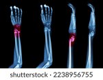 Small photo of X-ray forearm Comminuted fracture shaft of ulnar bone