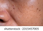 Small photo of Skin on the face that has deteriorated, large pores, spots, moles, blemishes or acne for the elderly. Facial skin lacks maintenance, dark spots, age deterioration.