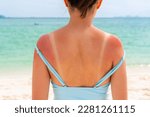 Sunburned skin on shoulder and back of a woman because of not using cream with sunscreen protection. Red skin sun burn after Sunbathing at the beach. Summer and holiday concept. Close up