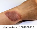 Small photo of Scald or steam burn on wrist of a dark skinned adult person isolated on white background. Close up photo of painful thermal injury from hot steam, accident due to careless behavior January 28, 2020