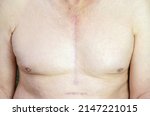 Small photo of Shirtless Caucasian man with scar mark from CABG (Coronary Artery Bypass Graft) on his chest. Open heart surgery. Healthy scar.