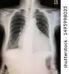 Small photo of Film chest x-ray PA upright showed cardiomegaly in mitral valve regurgitation patient