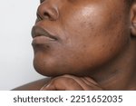 Brown skin with dark spots, hyperpigmentation on brown skin, african american woman with skin blemishes, imperfect skin
