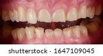 Small photo of The short and worn down teeth because of always hard biting, the result is improper plane of chewing and uneven size of teeth.
