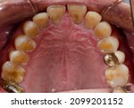 Small photo of The worn down nearly exposed pulp teeth and a gold dental crown