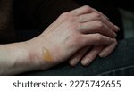 Small photo of Close-up of a woman's hand with a blister from a boiled water burn, damaged skin, 1st or second degree burn. Painful wound. Thermal burn. Water bladder from a burn, wound treatment.Macro photo.