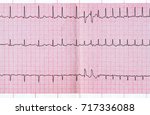 Small photo of Emergency cardiology. ECG with supraventricular extrasystole and short paroxysm of atrial fibrillation