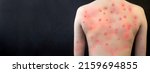 Small photo of MONKEYPOX. The girl's skin is blistered from monkeypox. Virus, epidemic, disease.Black background.