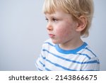 Small photo of portrait of little boy with allergic rash or eczema on face. severe allergic reaction, atopic skin