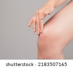 Small photo of Woman applying ointment on knee for pain and swelling reduction. Leg injury treatment concept. Bruise, sprain, arthritis, overuse. Health care concept. High quality photo