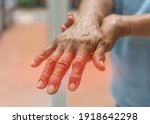 Small photo of Peripheral Neuropathy pain in elderly senipatient on hand, palm, finger and sensory nerves with numb, aching, muscle weakness, stabbing, burning from chronic inflammatory demyelinating polyneuropathy