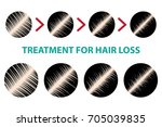 Treatment For Hair Loss Vector
