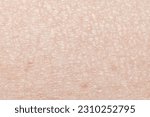 Small photo of Macro dry skin (fish scales) details. Dermatology and skincare concept with a view of a caucasian person's scaly skin. Dry and dehydrated skin of the body. Problematic skin.
