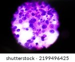 Small photo of Cytological study of intra abdominal mass: Spindle cell sarcoma, positive for malignant cells. Pleomorphic undifferentiated sarcoma, malignant fibrous histiocytoma.
