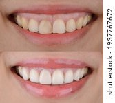 Small photo of Smile makeover before and after, gummy smile correction and ceramic veneers treatment.