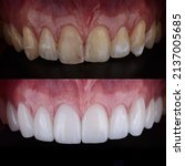 Small photo of Smile makeover with porcelain laminated veneers result in perfect smile and Hollywood white color.