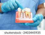 Doctor hold dental implant, artificial tooth roots into jaw, root canal of dental treatment, gum disease, teeth model for dentist studying about dentistry.