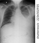 Small photo of Left Lower Lobe Hemothorax Chest X-Ray PosteroAnterior
