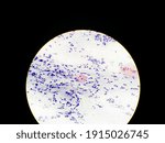 Small photo of Atypical Squamous Cell of Undetermined Significance cytology specimen conventional pap smear view in microscopy