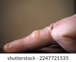 Small photo of Scalded finger. Gathering after contact with hot water. Scalding injury