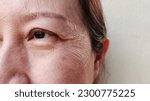 Small photo of portrait the flabbiness adipose hanging skin, flabby skin beside the eyelid, dark spots and blemish on the cheek, cellulite and edema under the eyes of the woman, health care and beauty concept.