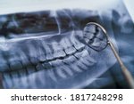 Dental instruments and jaw x-ray on white background. Panoramic jaw x-ray on white background. Dental treatment concept. Closeup.