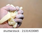 Selective focus of a human hand with a cornstarch powder clinging the skin from a worn medical powdered latex gloves causing allergy and hypersensitivity, powdered gloves are banned from usage by FDA