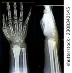 Small photo of A PXR plain x ray of right wrist joint of skeletally immature female child patient shows neglected physeal injury of right distal radius bone, Injury of The growth plate, or physis, selective focus