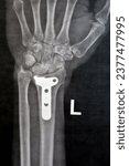 Small photo of Plain x ray showing a recent fissure fracture at the lower part of a left radius bone, also showing a previous internal fixation of the wrist joint with plate and screws of a previous fracture