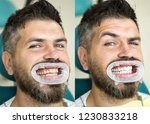 White Teeth   Before And After...
