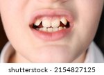 Small photo of Open mouth of a little boy with improperly growing teeth close-up.