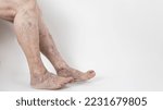 Small photo of Painful varicose veins and spider veins on active women's legs, helping oneself to overcome pain. Vascular disease, varicose vein problems, White background.