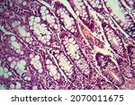 Small photo of Bacillary dysentery, light micrograph, photo under microscope showing presence of bacteria and accumulation of inflammatory cells in intestinal epithelium
