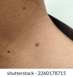 Small photo of Warts, close-up of a man's neck with warts on his neck.The point that connects to the shoulder a small polyp have dark grooves. It can be caused by sweat or bacteria. Need to cleaning the damp spots