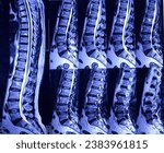 Small photo of MRI (magnetic resonance imaging) of Lumbo sacral Spine. L4-L5 and L5-S1 level thecal sac indentation with bilateral recesses effacement. Degenerative change in lumber spine. Osteophytic change L1-L5.