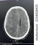 Small photo of Subdural hemorrhage and intraparenchymal hemorrhage area on the right in the computerized brain tomography of a 20-year-old female patient who was unconscious at home in Konya Turkey 2023