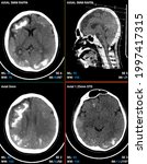 Small photo of head ct scan Sturge Weber syndrome 