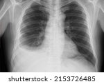 Small photo of Pleural effusion in chest x-ray, A pleural effusion is a collection of fluid in the pleural space, its shown as uniformly white lesion on chest x ray