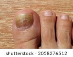 Toe nail with psoriasis and healthy toe nails; Psoriatic nail; close-up.