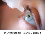 Small photo of Drops from vial dripping into woman eye closeup. Conjunctivitis treatment concept