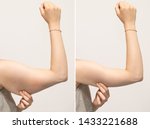 A split screen of a woman pinching the skin beneath her arm. Showing the before and after results of brachioplasty surgery, also called an arm lift.