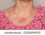 Small photo of Allergic reaction on a woman's neck. Widespread redness on the skin of a lady wearing metal necklaces. Concept of erythema for allergy to nickel or chromium of costume jewellery