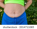 Small photo of Woman showing off her bare belly with striae or stretch marks following a pregnancy in a close up anonymous view of her midriff
